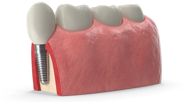 soft toothbrush for sensitive gums implant care